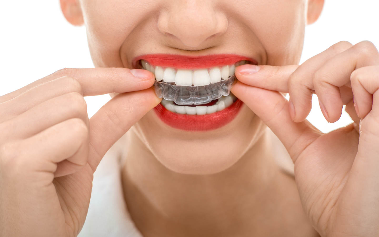 Invisalign Coventry Dentist Affords Discounted Orthodontic Invisible Braces